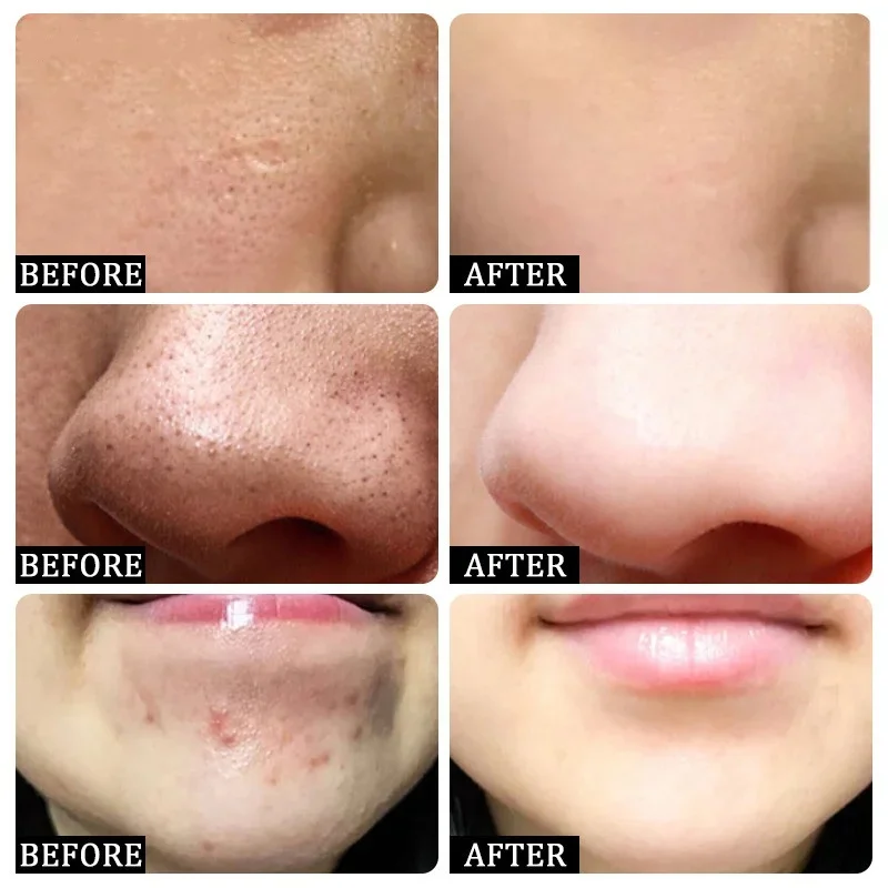 Salicylic Acid Pore Clearing C - Korean Lifestyle Products recension och pris