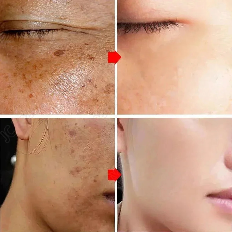 Whitening Freckle Cream Melasm - Korean Lifestyle Products recension och pris